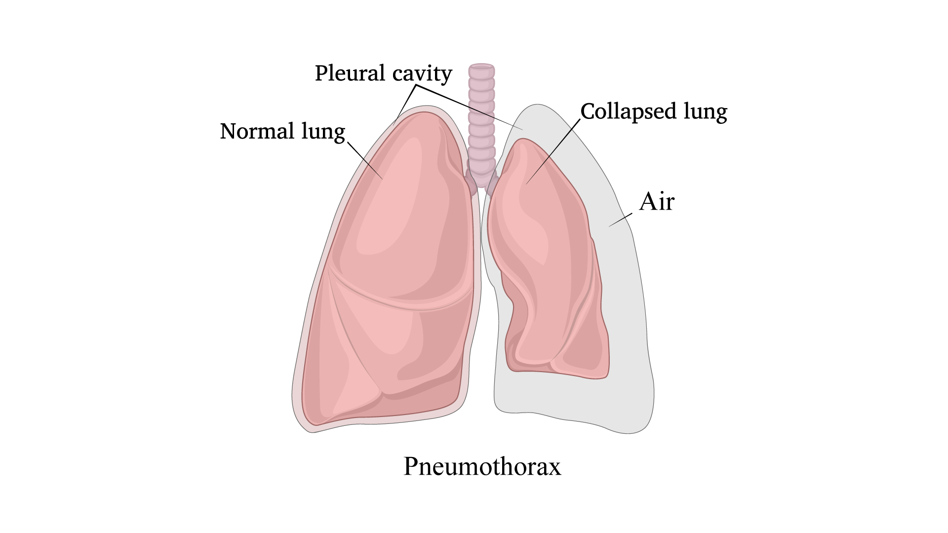 Pneumothorax (Collapsed Lung) Symptoms, Causes and Surgical ...