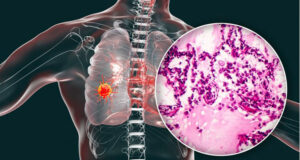 Read more about the article Lung Cancer and Covid 19