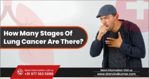 Read more about the article How Many Stages of Lung Cancer Are There?