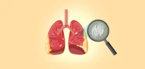 Read more about the article What Are The Options For Lung Cancer Treatment In India?