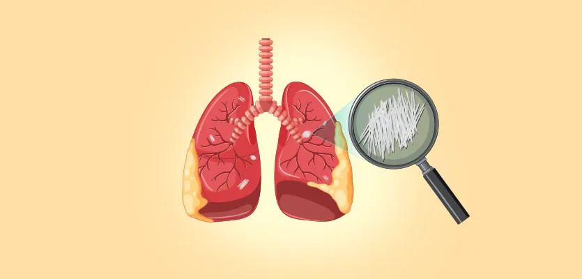 You are currently viewing What Are The Options For Lung Cancer Treatment In India?