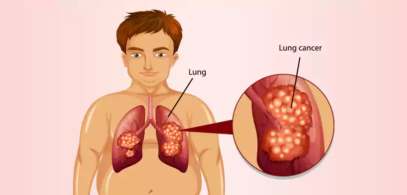 You are currently viewing Where Does Lung Cancer Usually Spread to First?