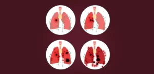Read more about the article Various stages of lung cancer