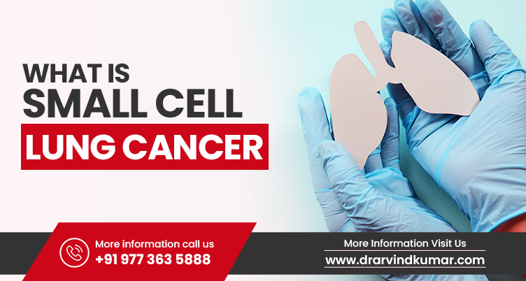 Small Cell Lung Cancer
