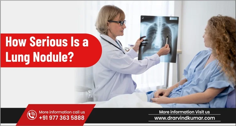 How Serious Is a Lung Nodule?