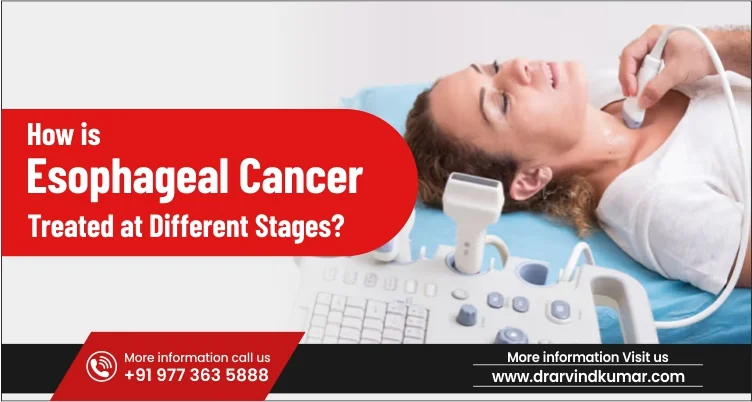 How Is Esophageal Cancer Treated at Different Stages?